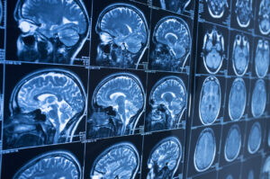 How Belt, Bruner & Barnett Personal Injury Lawyers Can Help You After a Brain Injury In Birmingham